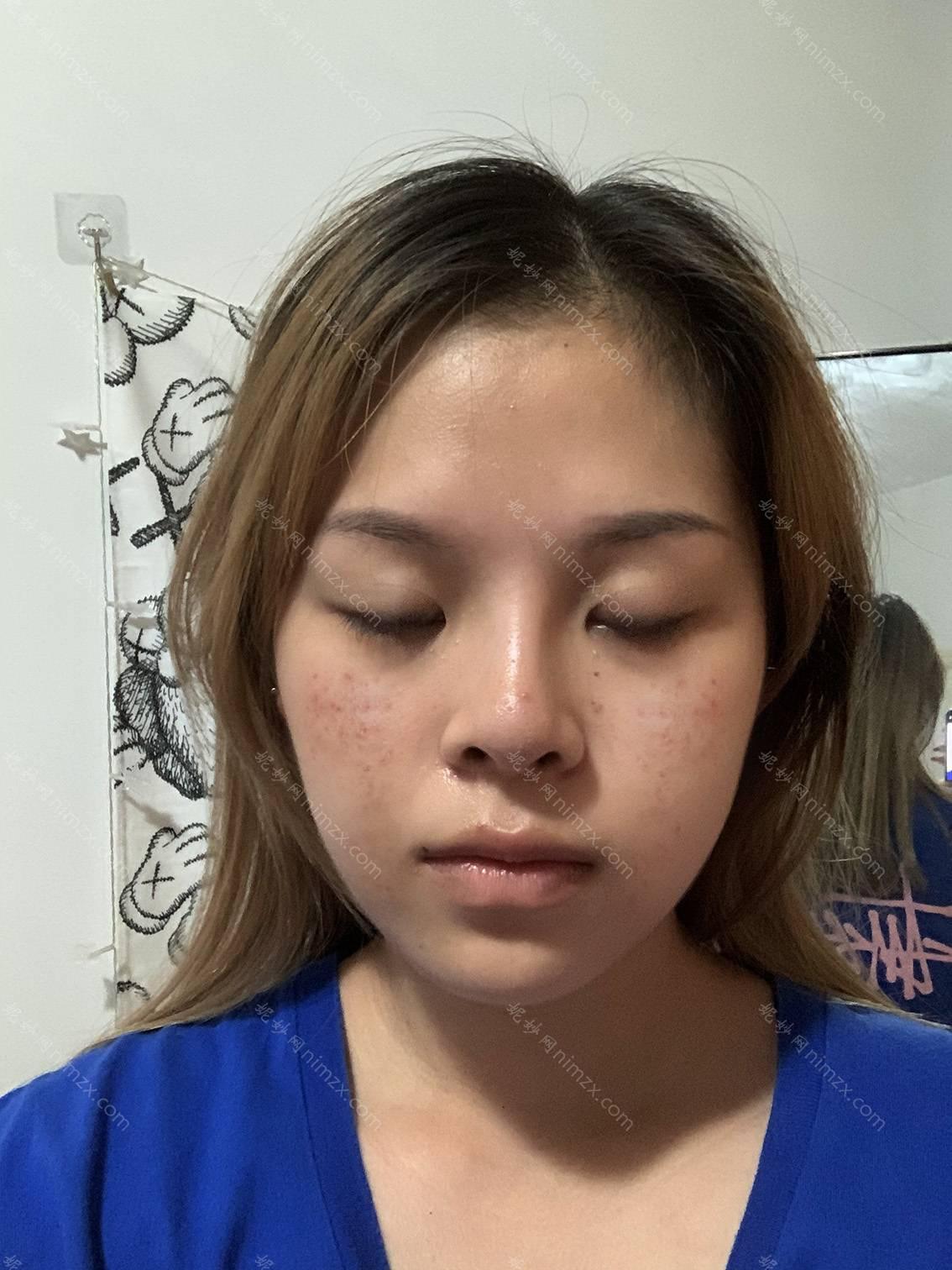 沈阳韩缘聚美医疗美容医院做激光去痘印好吗？附2022激光去痘印价格表