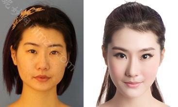 像素激光除皱以后要注意什么