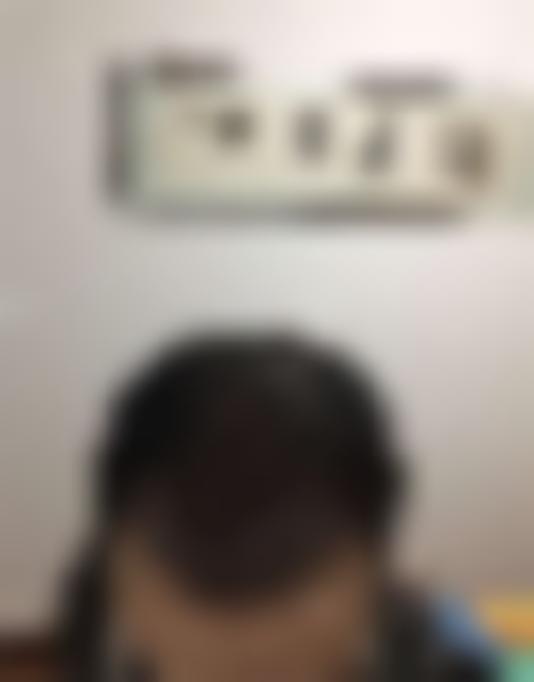 「济南博士园植发」怎么样?正规吗|案例|价格表