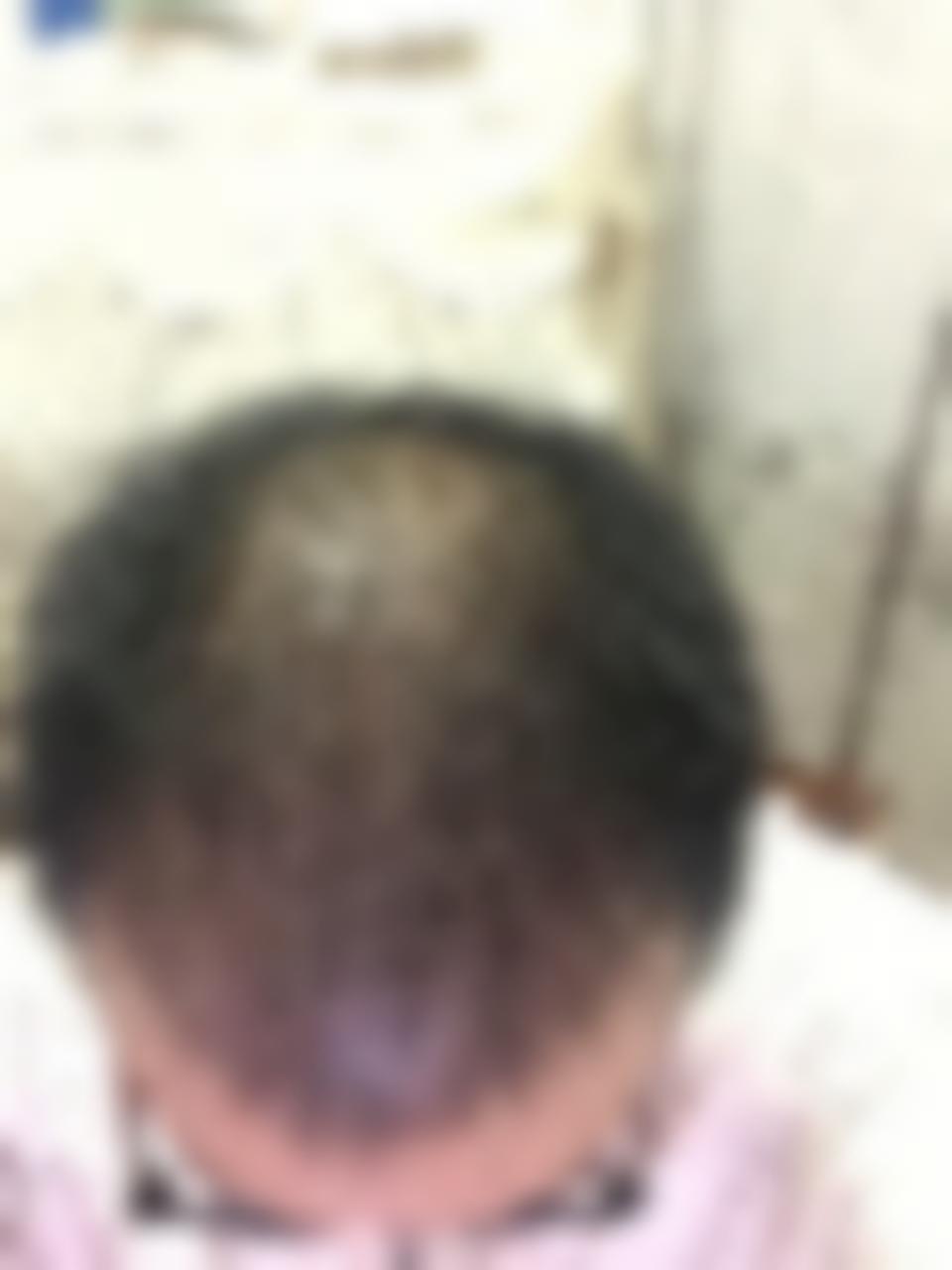 「济南博士园植发」怎么样?正规吗|案例|价格表