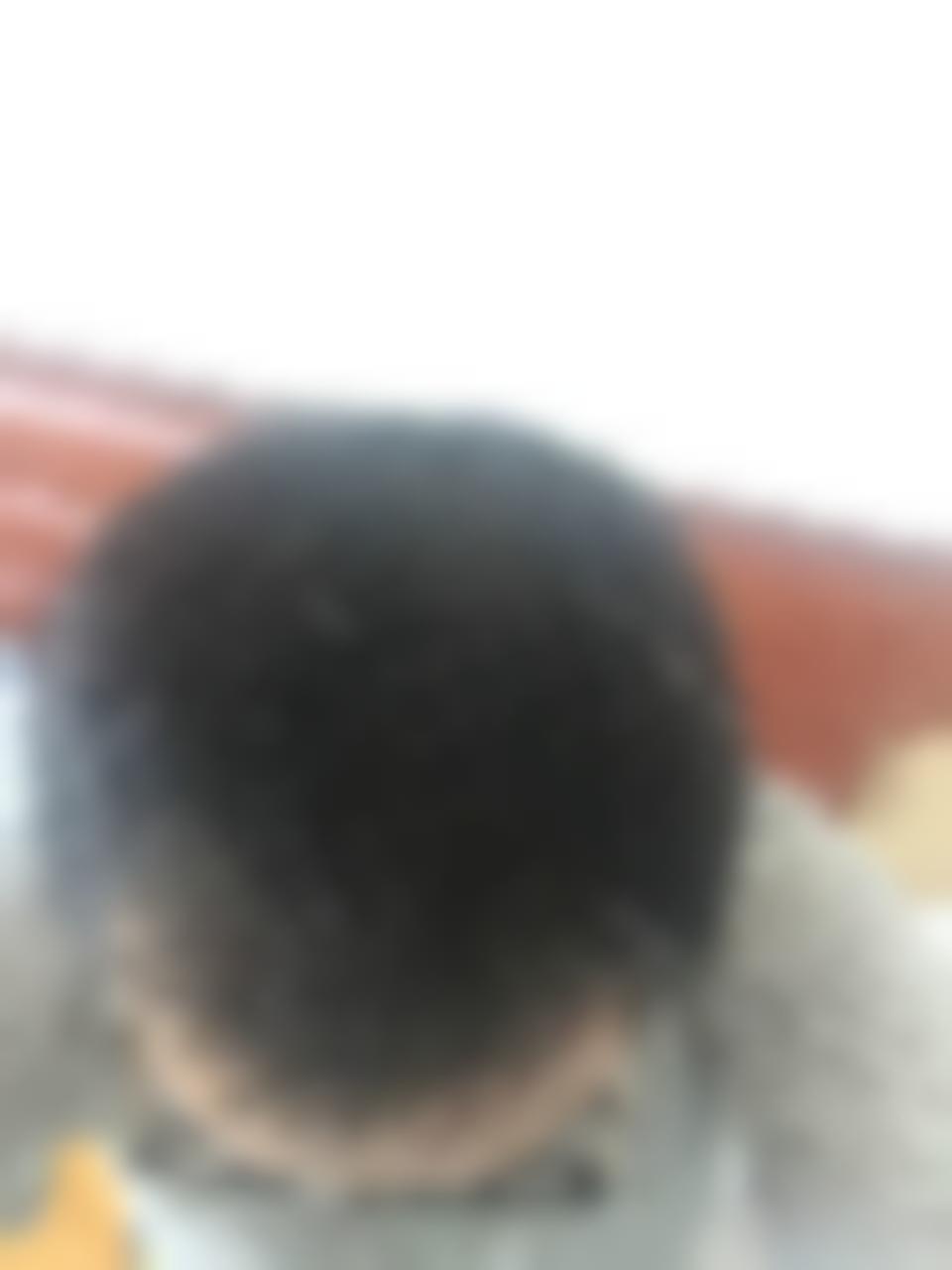 「济南博士园植发」怎么样?正规吗|案例|价格表