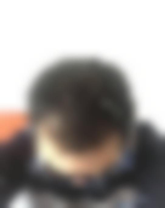 「济南博士园植发」怎么样?正规吗|案例|价格表