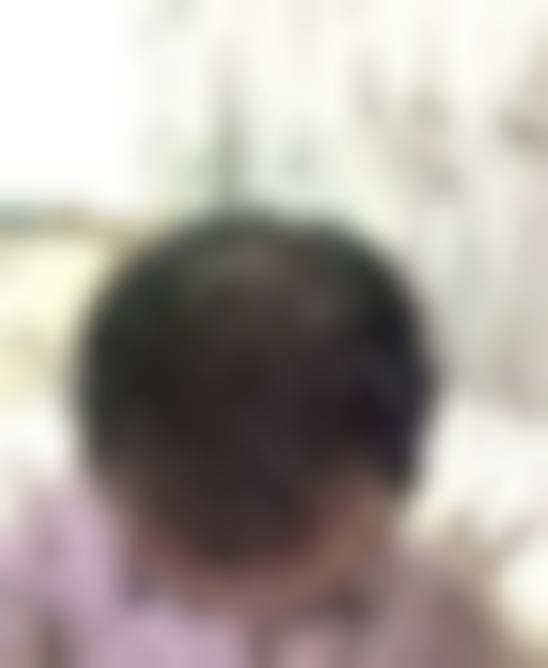 「济南博士园植发」怎么样?正规吗|案例|价格表