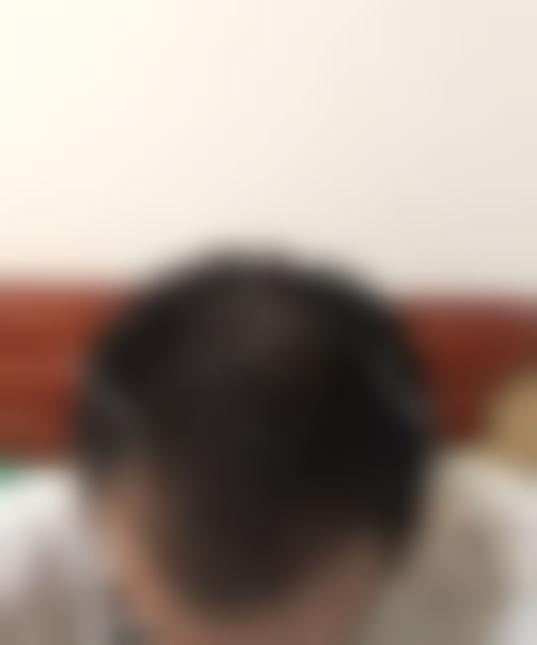 「济南博士园植发」怎么样?正规吗|案例|价格表
