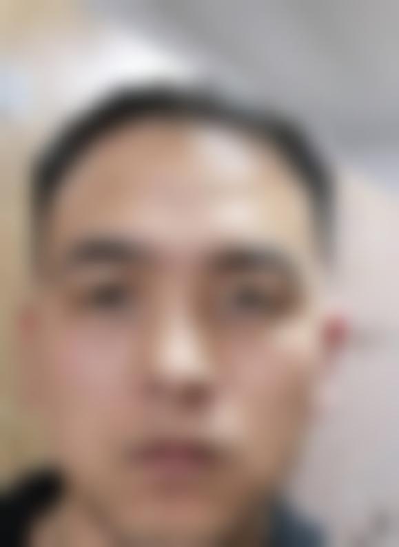 「昆明育森植发」怎么样?正规吗|案例|价格表