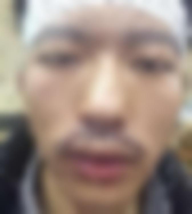 「东莞新生植发」怎么样?正规吗|案例|价格表