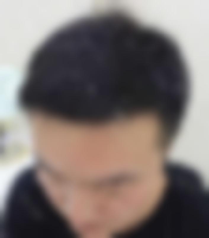 「保定熙朵植发」怎么样?正规吗|案例|价格表