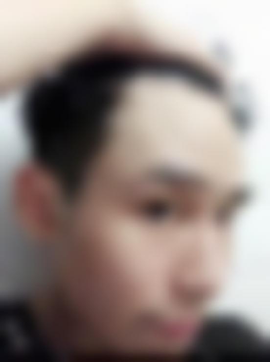 「珠海新生植发」怎么样?正规吗|案例|价格表