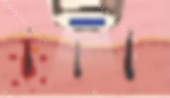 光子脱毛是永久性的吗？光子脱毛的操作原理是什么？需要准备什么吗？