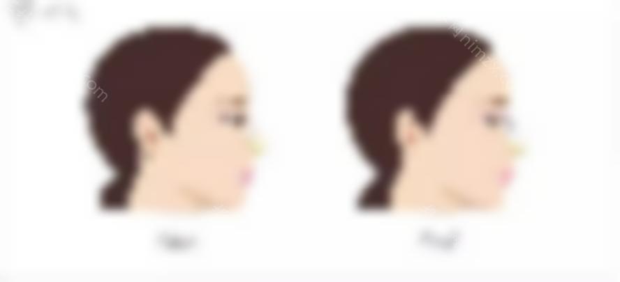 隆鼻后遗症？美莱齐一帆解锁鼻子综合\假体隆鼻术后六个答案