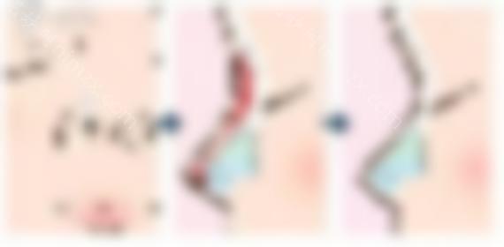 隆鼻后遗症？美莱齐一帆解锁鼻子综合\假体隆鼻术后六个答案