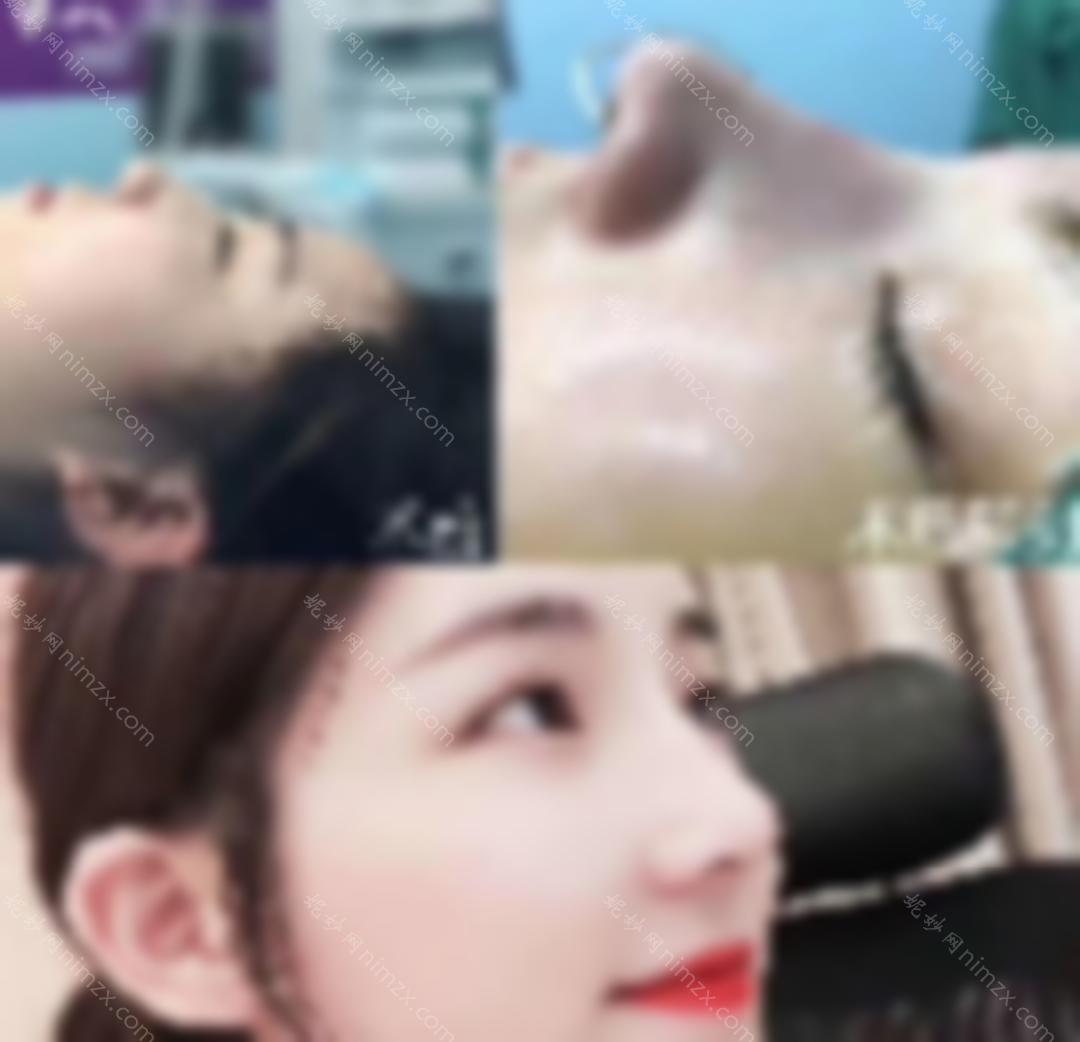 隆鼻后遗症？美莱齐一帆解锁鼻子综合\假体隆鼻术后六个答案