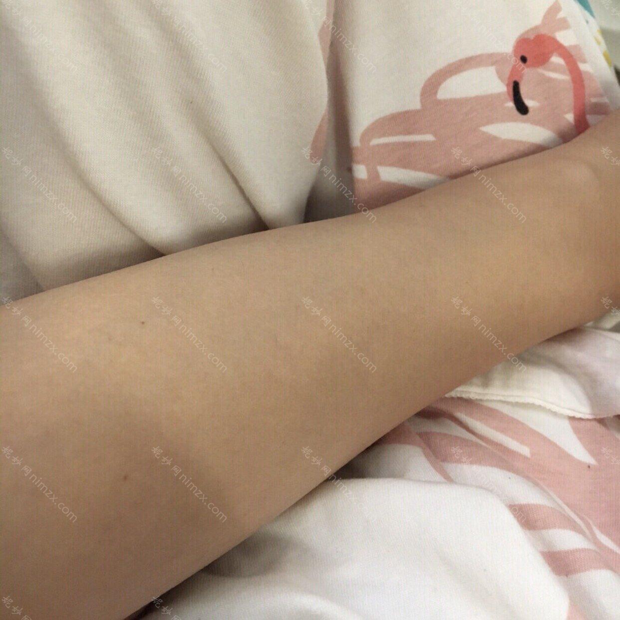 北京协和医院脱毛效果好不好?