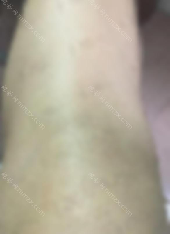 山东中医药大学第二附属医院口碑好吗？激光脱毛贵吗？价格表？