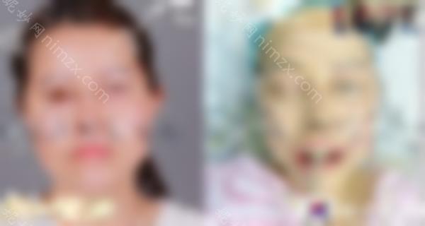 磨骨失败后悔能去上海愉悦美联臣修复吗？
