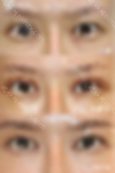 北京韩勋双眼皮修复技术怎么样？