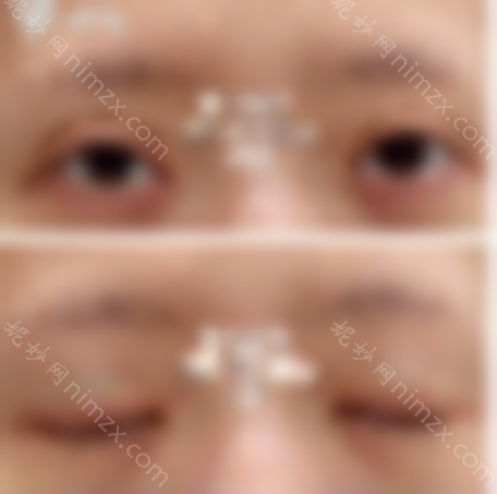 北京韩勋双眼皮修复技术怎么样？