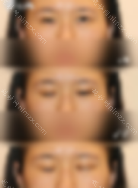 北京韩勋双眼皮修复技术怎么样？