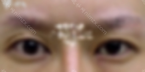 北京韩勋双眼皮修复技术怎么样？