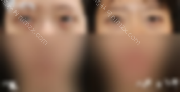 北京韩勋双眼皮修复技术怎么样？