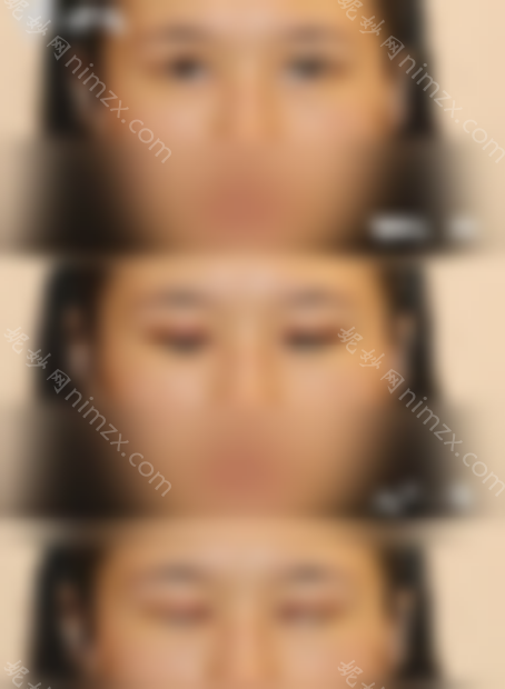 北京韩勋双眼皮修复技术怎么样？