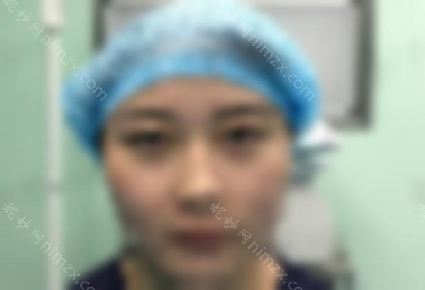 成都杨迪做双眼皮修复手术怎么样？内附真人整形实拍图介绍
