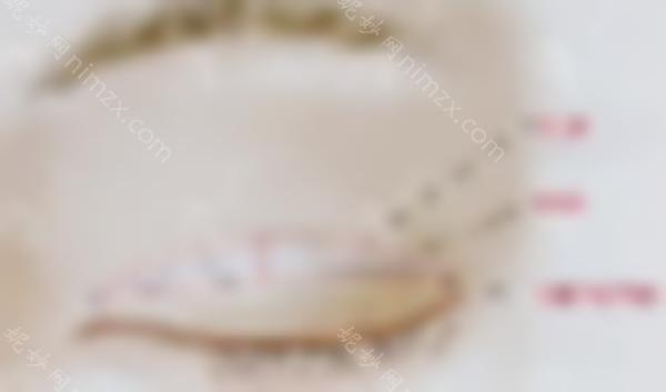 西安双眼皮修复医生排名公布，上榜的西安叶李旭平双眼皮修复怎么样？