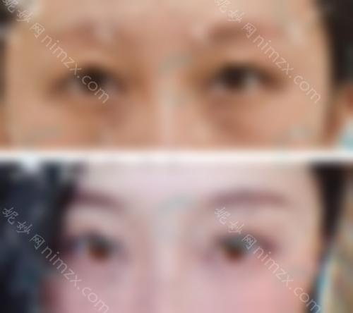 如何消除泪沟？北京领医高泽博和院长揭开谜底，看眶隔释放术后效果图
