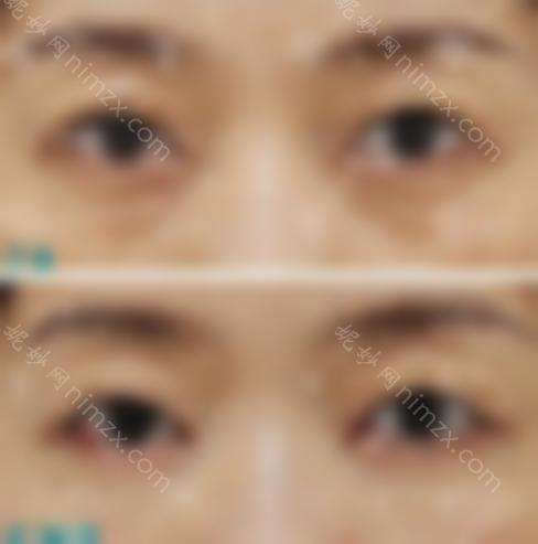 如何消除泪沟？北京领医高泽博和院长揭开谜底，看眶隔释放术后效果图