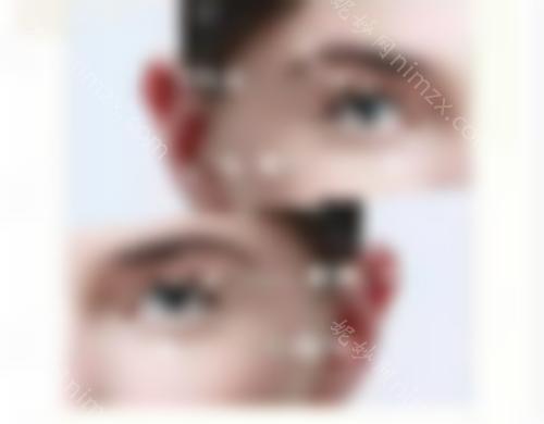 如何消除泪沟？北京领医高泽博和院长揭开谜底，看眶隔释放术后效果图