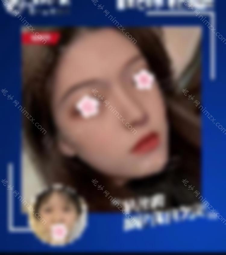 荆州华美杨荣博士综合隆鼻反馈好？隆鼻术后分享小姐妹们