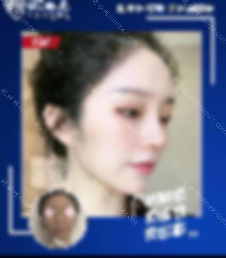 荆州华美杨荣博士综合隆鼻反馈好？隆鼻术后分享小姐妹们