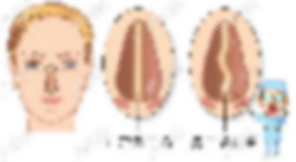 歪鼻矫正和鼻中隔偏曲矫正一样吗？他们能一起做吗？