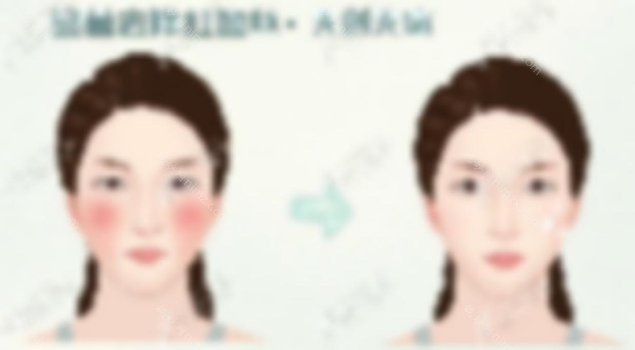 想要去除高原红面部红血丝就来兰州时光反正做一次也不贵