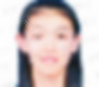 哈尔滨医科大学较好医院激光无痛脱毛多少钱？|整形医生|分享脱毛案例