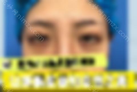 郑州周凯修复双眼皮怎么样？了解医生的信息很重要！双眼皮修复案例