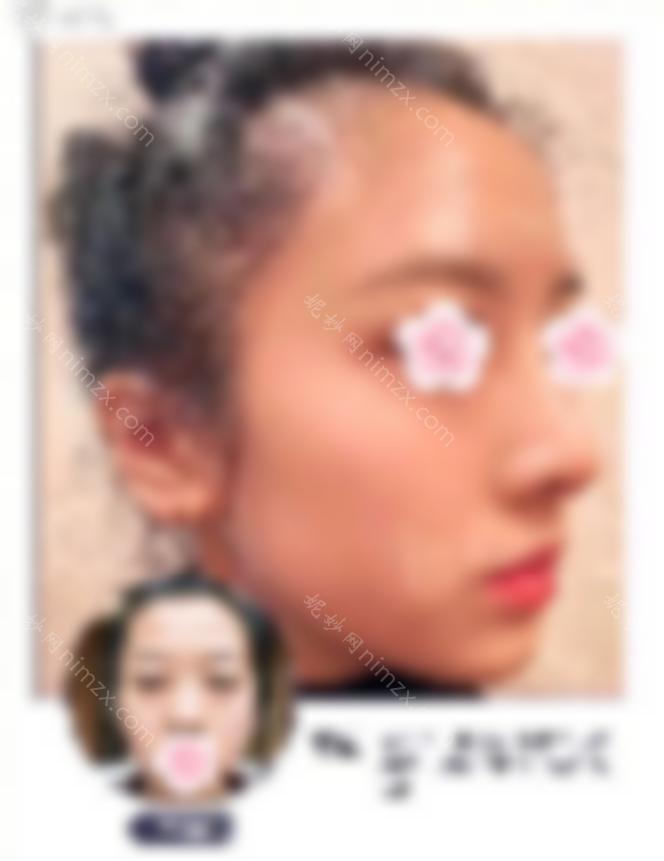 荆州华美杨荣博士综合隆鼻反馈好？隆鼻术后分享小姐妹们