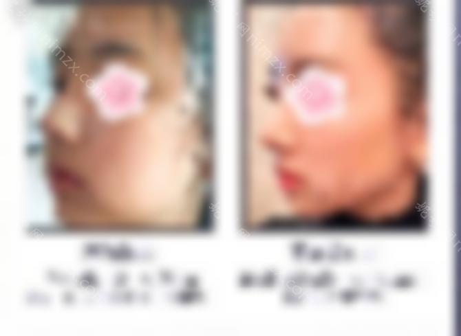 荆州华美杨荣博士综合隆鼻反馈好？隆鼻术后分享小姐妹们