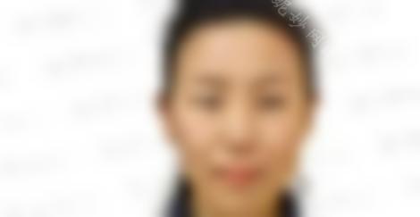 秦皇岛较好医院整形科无痕开眼角多少钱？开眼角手术效果好吗？