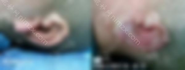 去西安国际再造耳面诊找郭树忠怎么样？你需要做多少期？看看郭树忠耳朵的效果