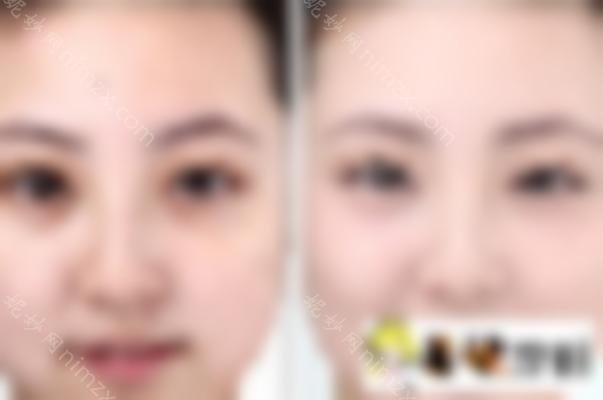 什么是光子祛斑？术后应该如何护理？