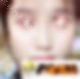 郑东学鼻子案例图_隆鼻病例照片