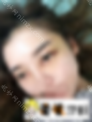 二炮总医院整形开眼角 双眼皮案例，术后效果没得说！