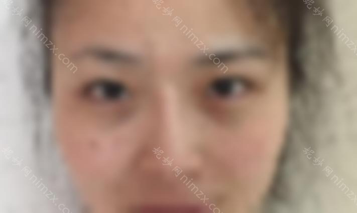 秦皇岛较好医院整形科无痕开眼角多少钱？开眼角手术效果好吗？