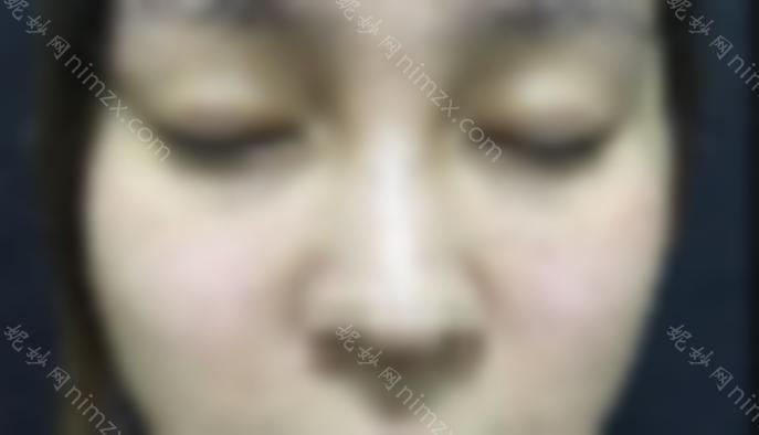 重庆真伊整形双眼皮修复贵吗？医院里的医生技术比较好？过来看看。