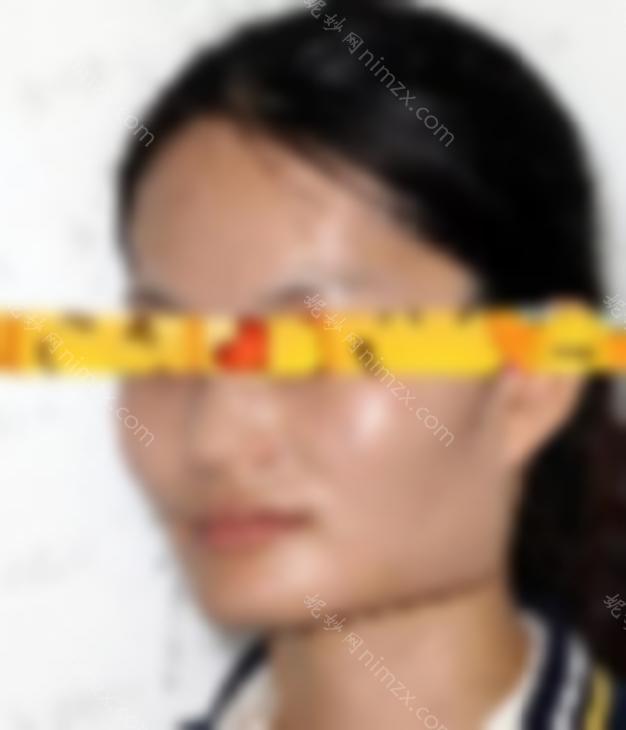 西南医院王振祥磨骨病例：医生综合实力分析 磨骨手术真实病例分享