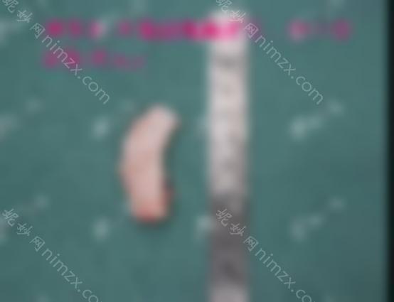 母亲的鼻子多少钱是由什么材料决定的，通常是耳软骨