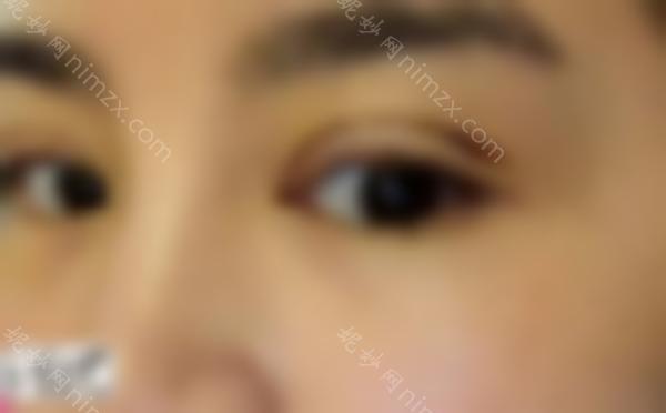 眼睛修复过宽的双眼皮修复，双眼皮宽窄怎么办？