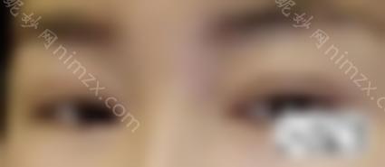 眼睛修复过宽的双眼皮修复，双眼皮宽窄怎么办？