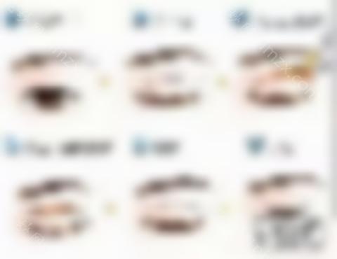 眼睛修复过宽的双眼皮修复，双眼皮宽窄怎么办？
